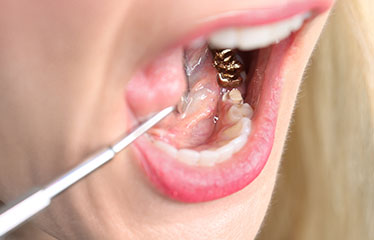 歯の治療風景