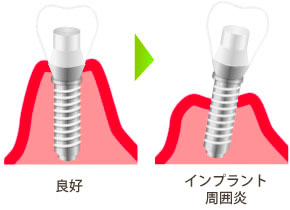 インプラント歯周炎