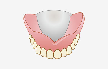金属床義歯