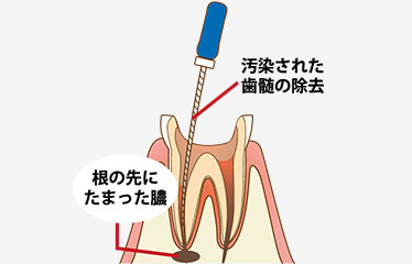 古い薬の除去