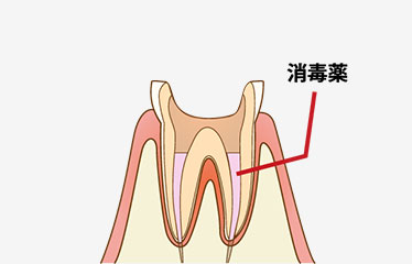 消毒