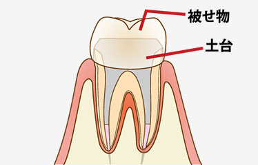かぶせ物の治療