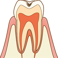 エナメル質に達する虫歯