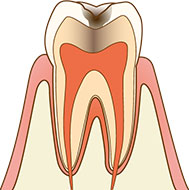 象牙質に達するむし歯