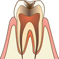 神経に達する虫歯