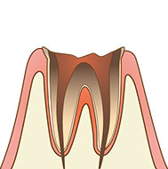 神経に達する虫歯