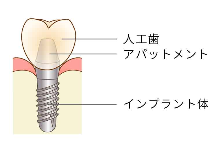 インプラントについて