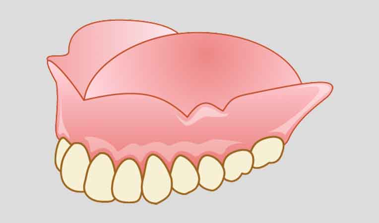 入れ歯のメリット・デメリット