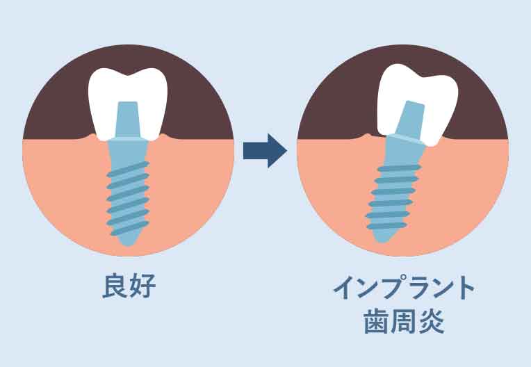 インプラント歯周炎