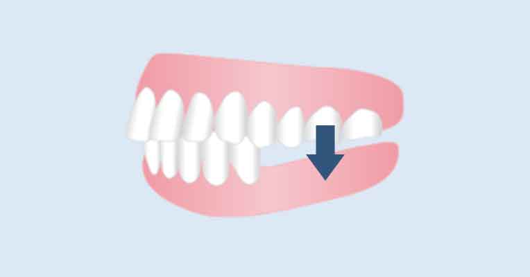 歯を抜けたままにしていると？ | 医療法人社団 池田会 インプラント解説サイト
