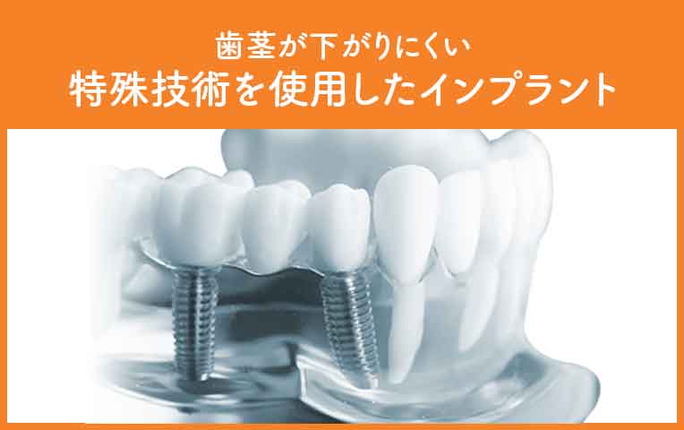 歯茎が下がりにくい特殊技術を使用したインプラント