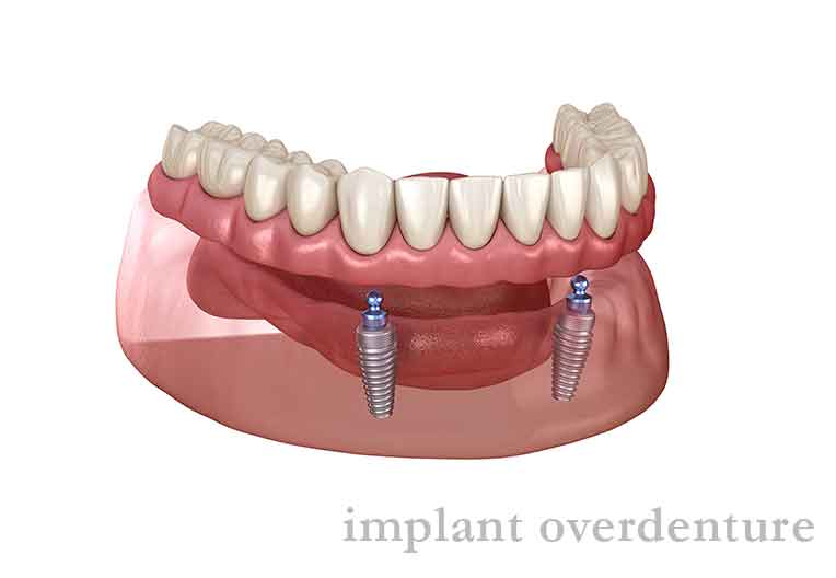インプラントオーバーデンチャー