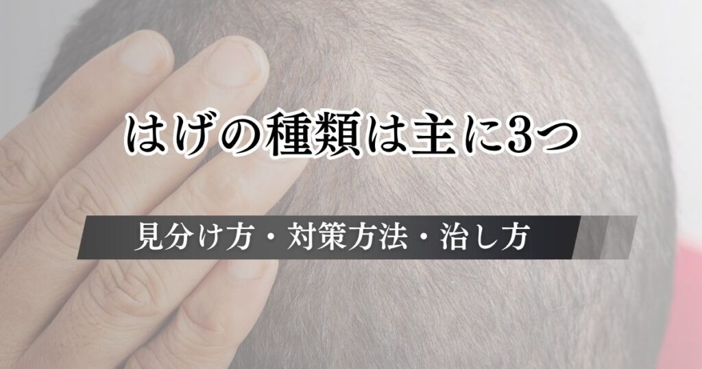 はげの種類はM字・U字・O字が代表的！男性・女性ごとの見分け方と薄毛別の特徴・対策方法