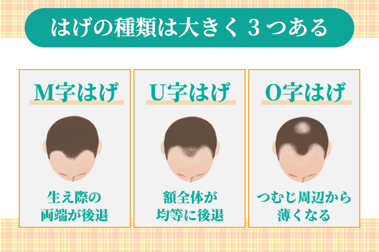 はげの種類は大きく3つある（M字・U字・O字）