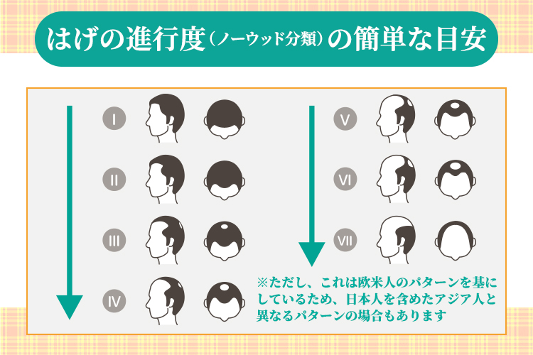 はげの進行度（ノーウッド分類）の簡単な目安