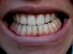 bruxism_implant_01