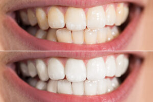 home_whitening_01