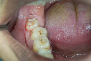 wisdomtooth_trouble_01