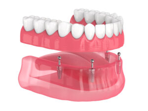 completedenture_implant_01